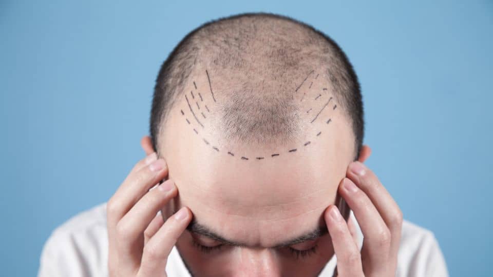 השתלת שיער בטורקיה